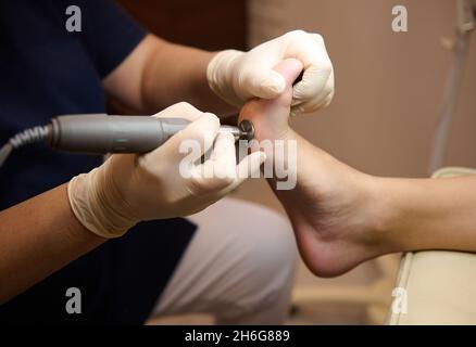 Gros plan d'un patient sur la procédure médicale de pédicure, visite de podiatre, réception de matériel de la procédure d'épluchage avec machine électrique Banque D'Images