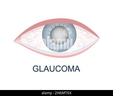 Vue rapprochée de l'œil avec glaucome.Brumeux, rougeur, globe oculaire aqueux.Organe de vision humain anatomique précis.Problèmes visuels de vieillissement.Illustration vectorielle. Illustration de Vecteur