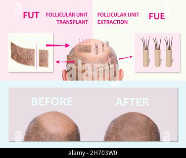 Méthodes de transplantation de cheveux FUT et FUE Fue avec la transplantation comme élément d'illustration. Alopécie humaine ou problème de perte de cheveux sur l'homme adulte âgé ou mature. Avant et après le concept Banque D'Images