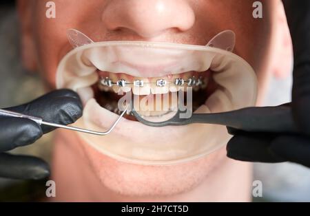 Photographie macro de la bouche de l'homme avec des bretelles métalliques et un enrouleur de joue.Les mains du dentiste dans des gants en caoutchouc faisant le contrôle des dents avec des outils dentaires.Image rognée.Vue de dessus.Concept d'hygiène buccale Banque D'Images