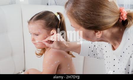 Petite fille avec la varicelle, crème antiseptique appliquée à l'éruption.Mère appliquant de la crème antiseptique sur une petite fille triste avec la varicelle à la maison Banque D'Images