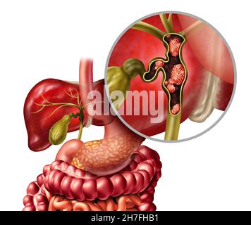 Cancer du canal biliaire ou cholangiocarcinome avec une vésicule biliaire et le foie comme une maladie du système digestif représentant un soin de santé médical. Banque D'Images