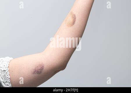 Bras d'une femme de race blanche.Elle tient le bras dans l'air pour révéler deux grandes ecchymoses. Banque D'Images