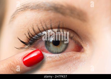 Femme pointant du doigt œil rouge souffrant d'allergie Banque D'Images