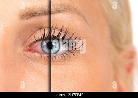 Macro de l'œil bleu d'une femme avec et sans rougeur, avant et après l'utilisation de la dropsMacro de Banque D'Images