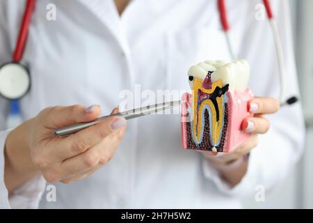 Médecin montrant une cavité carieuse avec stylo à bille sur un modèle de dent artificielle en plastique Banque D'Images