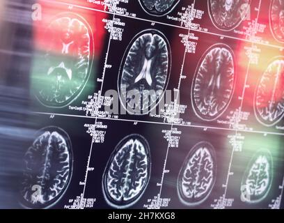 IRM du cerveau en clinique Banque D'Images