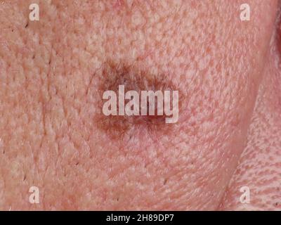 Mélanome de Dubreuilh Photo Stock - Alamy