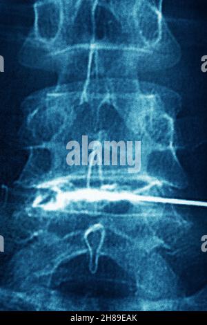 Infiltration de corticostéroïdes Banque D'Images