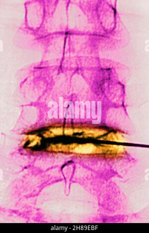 Infiltration de corticostéroïdes Banque D'Images