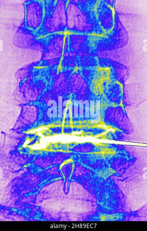 Infiltration de corticostéroïdes Banque D'Images