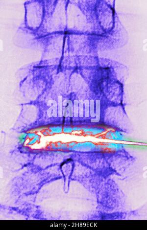 Infiltration de corticostéroïdes Banque D'Images