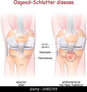 Maladie d'Osgood–Schlatter.Articulation et apophysite sains du tubercule tibial.Illustration vectorielle.Affiche à usage médical Illustration de Vecteur