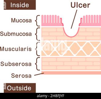 Illustration de la vue en coupe de l'ulse gastrique Illustration de Vecteur