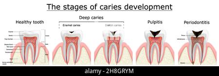 Étapes de développement des caries.Maladie dentaire: Caries, pulpite et parodontite, illustration réaliste de vecteur Illustration de Vecteur