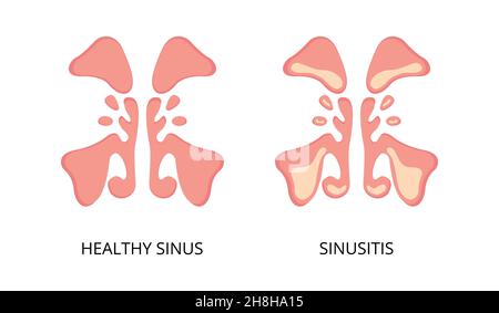Image plate des sinus et des sinusites en bonne santé.Infection, inflammation, maladies nasales.Peut être utilisé pour des sujets tels que la santé, le diagnostic, l'anatomie Illustration de Vecteur