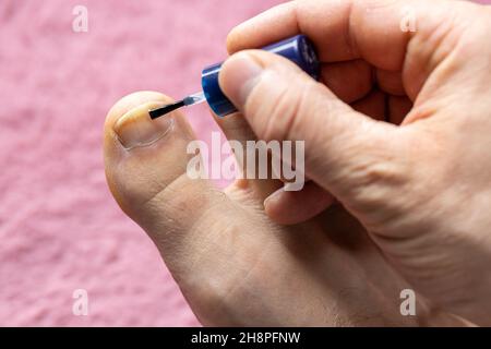 onychomycose, stade initial de la teigne tonsurante.Peindre le gros orteil avec un vernis médicamenteux, fond rose pacifique Banque D'Images