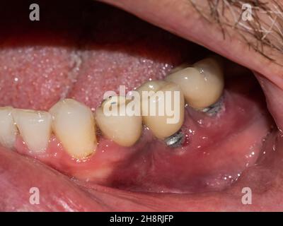 Image en gros plan d'un pont dentaire avec des couronnes, montrant le travail dentaire détaillé et l'hygiène buccale sur la mâchoire inférieure Banque D'Images