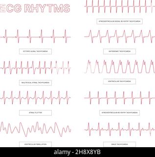 Modèles d'ECG.Lignes d'infographies médicales cœur arythmie santé dessins conceptuels pour les médecins info garache vecteur illustrations ecg Illustration de Vecteur