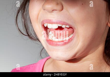 Une jeune fille de race blanche avec des dents entassant montre l'intérieur de sa bouche dans une salle d'examen de dentiste.L'un des incisives avant est mal aligné, ce qui entraîne une prob Banque D'Images