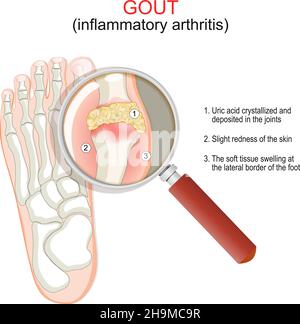 Goutte.Gros plan d'une articulation avec arthrite inflammatoire.Pied humain avec cristallisation de l'acide urique et de la loupe.Illustration vectorielle. Affiche e Illustration de Vecteur