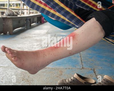 La jambe d'un touriste brûlée dans le soleil amazonien dans la forêt amazonienne.Amazonie.Amérique du Sud Banque D'Images