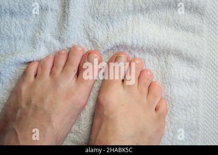 Détails des ongles d'homme avec infection fongique connue sous le nom de mycose, lumière naturelle Banque D'Images