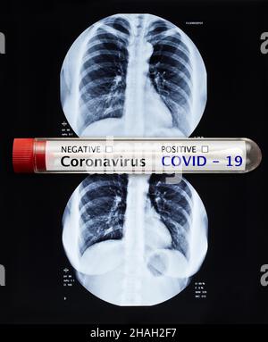 Test du coronavirus et image radiologique des poumons humains pour un diagnostic médical Banque D'Images