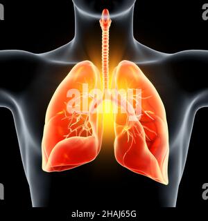 3D Illustration montrant une pneumonie, des poumons infectés Banque D'Images