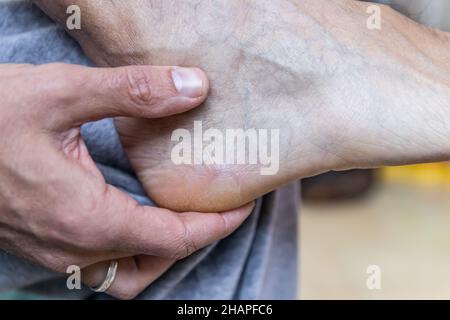 Cloques sur le pied d'un homme caucasien assis sur le canapé à la maison Banque D'Images