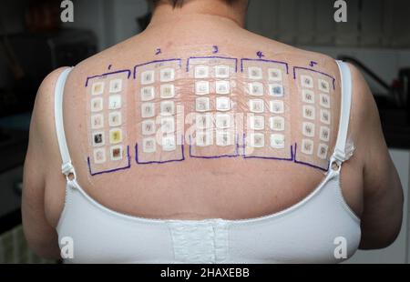 NHS SKIN PATCH TEST ON WOMANS BACK RE SANTÉ ALLERGIES ALLERGIES ALLERGIES ALLERGÈNES ECZÉMA ETC UK Banque D'Images