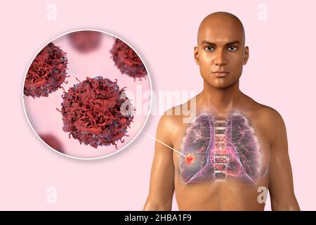 Cancer du poumon.Illustration d'un ordinateur montrant une tumeur à l'intérieur du poumon droit d'un homme et une vue rapprochée des cellules cancéreuses. Banque D'Images