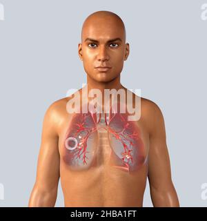 Tuberculose pulmonaire fibreuse-caverneuse.Illustration informatique montrant une caverne (cavité) dans le poumon droit avec une couche fibreuse bien formée dans sa paroi. Banque D'Images