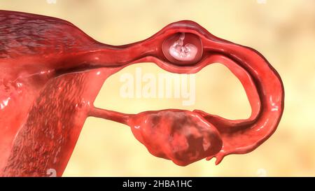 Grossesse extra-utérine, de l'illustration. L'embryon a implanté dans la trompe de Fallope, et non dans l'utérus. Banque D'Images