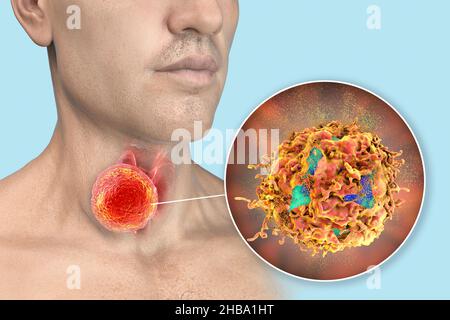 Traitement du cancer de la thyroïde.Illustration informatique conceptuelle montrant le cancer de la glande thyroïde avec une vue rapprochée de la destruction des cellules cancéreuses. Banque D'Images