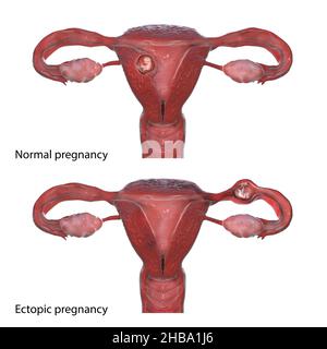 Grossesse normale (haut) et ectopique (bas), illustration de l'ordinateur.Pendant la grossesse extra-utérine, l'embryon s'est implanté dans la trompe de Fallope, pas dans l'utérus. Banque D'Images