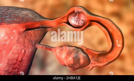 Grossesse extra-utérine, de l'illustration. L'embryon a implanté dans la trompe de Fallope, et non dans l'utérus. Banque D'Images