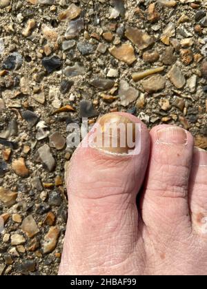 Soins de l'ongle pour le champignon de l'ongle - épaississement de l'ongle du gros orteil d'une personne souffrant d'Onychomycose, une infection fongique causant jaunissement et épaississement Banque D'Images