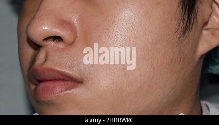 Peau équitable avec de larges pores sur le visage huileux du jeune homme adulte d'Asie du Sud-est, du Myanmar ou de Corée. Banque D'Images