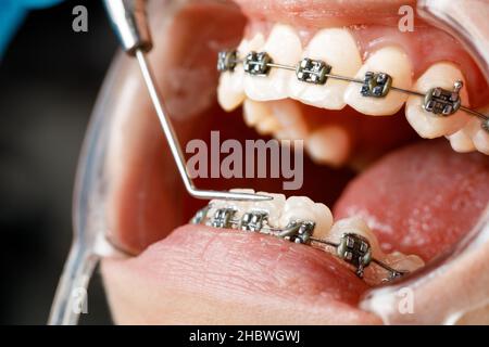 Une jeune femme avec des bretelles métalliques est examinée par un orthodontiste.Correction de la morsure des dents dans la clinique dentaire.Concept de dents saines. Banque D'Images