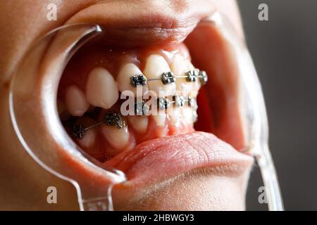 Une jeune femme avec des bretelles métalliques est examinée par un orthodontiste.Correction de la morsure des dents dans la clinique dentaire.Concept de dents saines. Banque D'Images