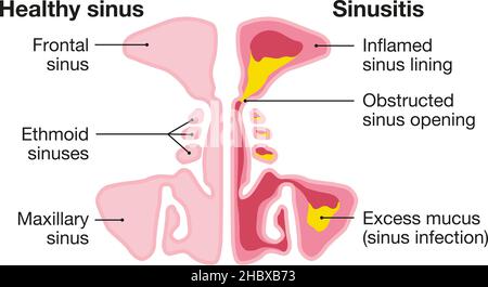 Illustration vectorielle montrant un sinus et une sinusite sains avec une doublure enflammée, une ouverture du sinus obstruée, un adénoïde et un mucus en excès Banque D'Images