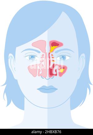 Illustration vectorielle montrant un sinus et une sinusite sains avec une doublure enflammée, une ouverture du sinus obstruée, un adénoïde et un mucus en excès Banque D'Images