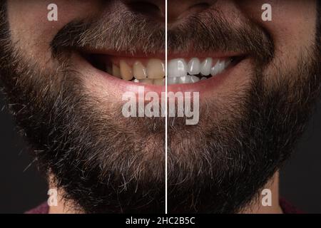 Homme souriant avant et après la procédure de blanchiment des dents, gros plan. Blanchissement des dents blanchiment laser chez homme dent comparer avant après traitement dans Banque D'Images