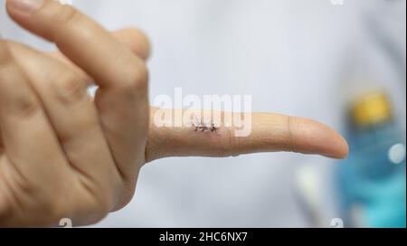 Des points de suture chirurgicaux du doigt d'une femme après avoir sectionné l'excédent de morceau. Banque D'Images