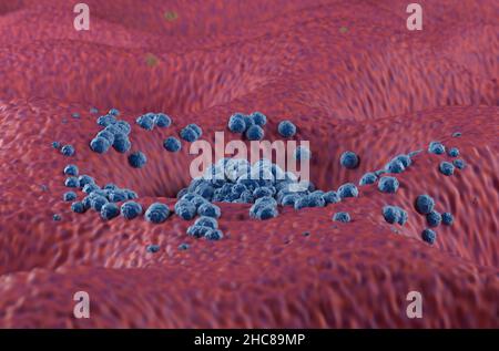 Cancer gastrique à un stade précoce tumeur sur le côté de la paroi de l'estomac vue rapprochée 3D illustration Banque D'Images