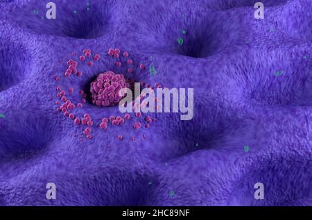 Cancer gastrique à un stade précoce tumeur sur la paroi de l'estomac vue isométrique 3D illustration Banque D'Images