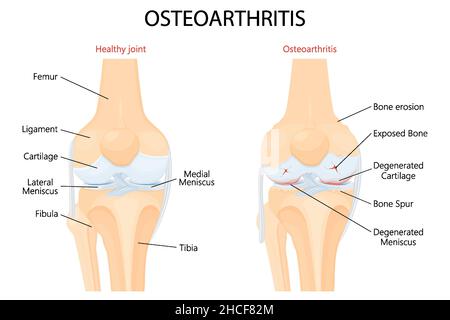 Arthrose du genou et anatomie détaillée des articulations normales.Arthrose.Arthrite ou douleur dans une articulation. Maladie dégénérative de l'articulation.Le cartilage devient Illustration de Vecteur