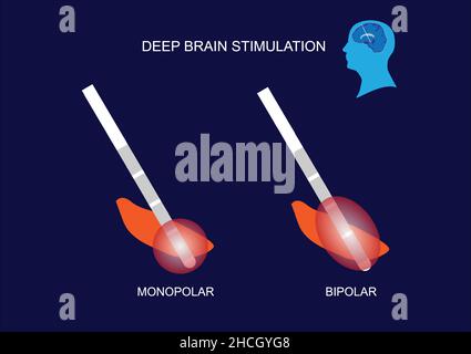 Stimulation cérébrale profonde au noyau subthalamique pour le traitement de la maladie de Parkinson.Mode de stimulation.Stimulation monopolaire et bipolaire. Illustration de Vecteur