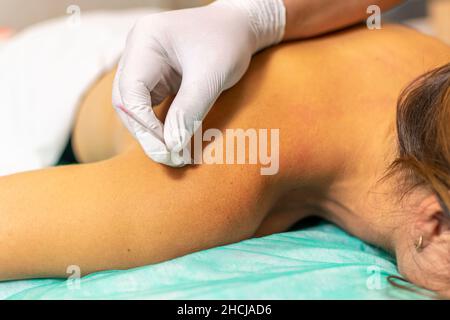 Détail de la jeune femme caucasienne recevant un traitement à aiguilles sèches.Mise au point sélective Banque D'Images